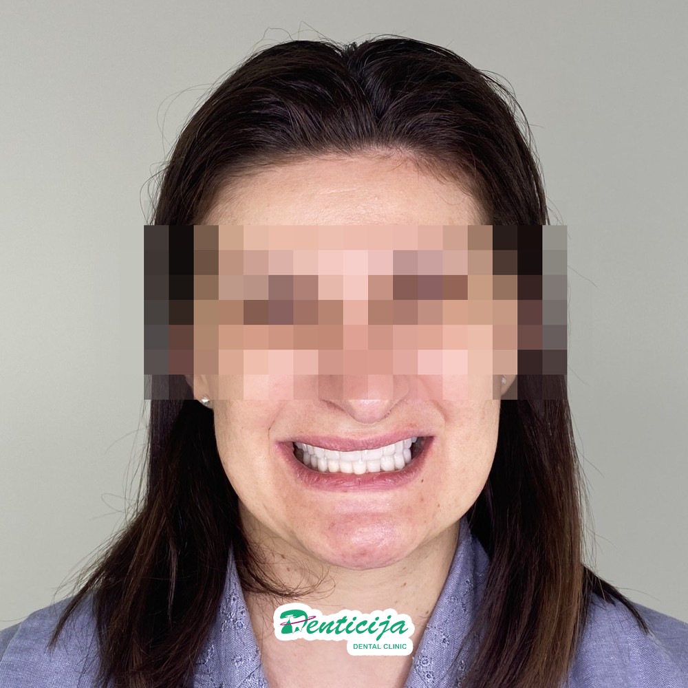 Целосна орална рехабилитација - приказ на случај - Denticija Dental ...